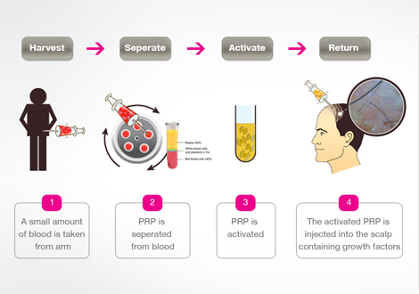 PRP Therapy Dubai