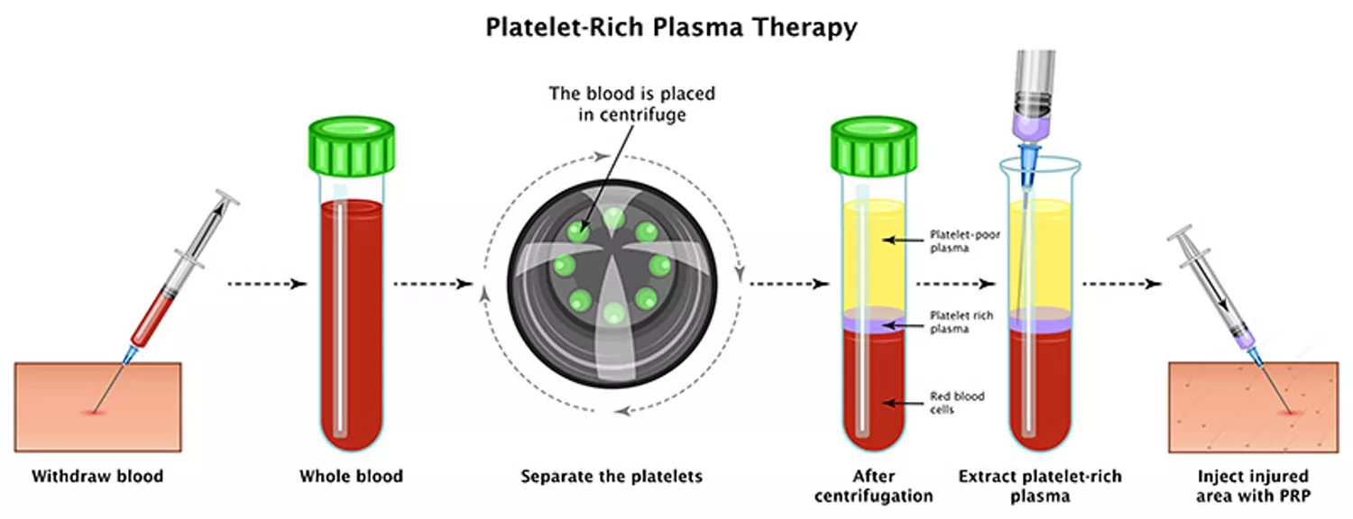 PRP Therapy Dubai